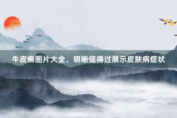 牛皮癣图片大全，明晰信得过展示皮肤病症状